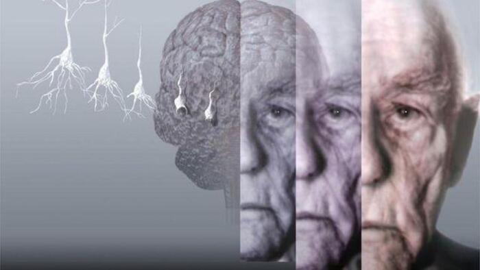 Доклад: Болезнь Альцгеймера: симптоматология и терапия